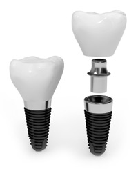 Cosmetic Dental Implant