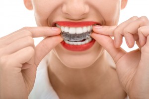 Invisalign treatment